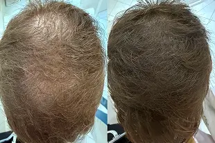 14 meses de tratamento